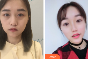 肇慶華美整形美容醫(yī)院陳巍整形價格表附熱瑪吉案例展示