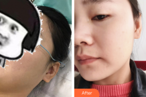 肇慶民和醫(yī)院激光整形科馮士彬整形價格表附光子嫩膚案例展示