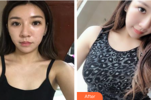 肇慶華美整形美容醫(yī)院方林均整形價格表附假體隆胸案例展示