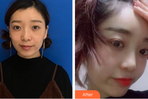 肇慶市高要區(qū)人民醫(yī)院整形激光美容科司義湘整形價格表附玻尿酸精華導(dǎo)入案例展示