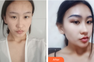 肇慶民和醫(yī)院激光整形科殷運成住院醫(yī)師整形價格表附眼部手術(shù)案例展示