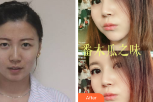 肇慶民和醫(yī)院激光整形科唐海軍整形價格表附全切雙眼皮案例展示