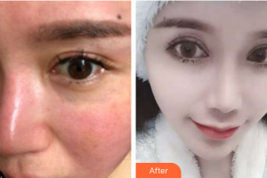 肇慶市皮膚病醫(yī)院醫(yī)療美容科王先文整形價格表附激光祛紅血絲案例展示