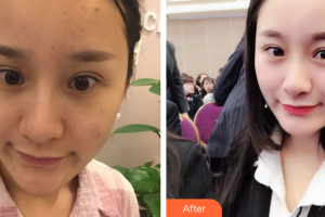 肇慶市皮膚病醫(yī)院醫(yī)療美容科葉偉整形價格表附去痘印痘坑案例展示