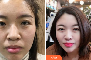 肇慶市皮膚病醫(yī)院醫(yī)療美容科莫家亮整形價格表附光子嫩膚案例展示