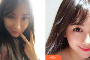 肇慶市皮膚病醫(yī)院醫(yī)療美容科陳潔華整形價格表附光子嫩膚案例展示