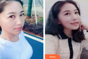 肇慶市皮膚病醫(yī)院醫(yī)療美容科韋方銓整形價格表附點陣激光祛妊娠紋案例展示