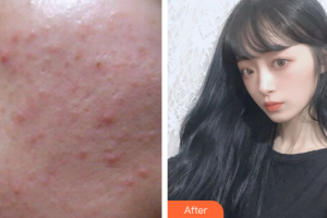 肇慶市皮膚病醫(yī)院醫(yī)療美容科何翠英整形價格表附微針水光案例展示