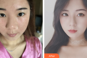 肇慶市皮膚病醫(yī)院醫(yī)療美容科馮嬌娜整形價格表附去痘印痘坑案例展示