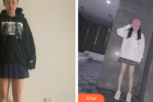 肇慶市皮膚病醫(yī)院醫(yī)療美容科李潔整形價格表附	縫針疤痕案例展示