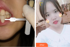 肇慶中大口腔醫(yī)院曾榮華整形價格表附超聲波潔牙案例展示