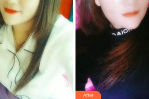 肇慶中大口腔醫(yī)院周永標整形價格表附時代天使矯正案例展示