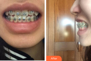 肇慶中大口腔醫(yī)院伍建庭整形價格表附金屬矯正案例展示