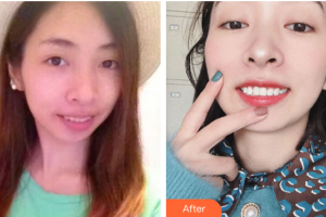 肇慶中大口腔醫(yī)院鐘鏡亮整形價格表附自鎖矯正案例展示