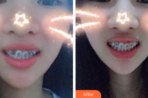 肇慶中大口腔醫(yī)院韋芳梅整形價格表附自鎖托槽矯正案例展示