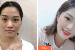 梅州曙光醫(yī)療美容醫(yī)院黃丹整形價(jià)格表附光子嫩白案例展示