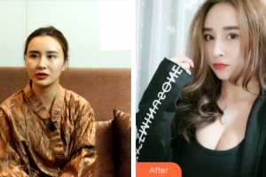 梅州曙光醫(yī)療美容醫(yī)院整形價(jià)格表附自體脂肪隆胸案例展示