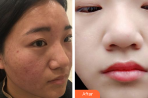 東莞中韓醫(yī)療美容診所何玲整形價(jià)格表附果酸＋點(diǎn)陣案例展示