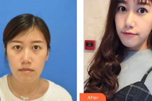 東莞現(xiàn)代女子醫(yī)療美容診所程壽濤整形價(jià)格表附激光去眼袋案例展示