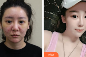 東莞現(xiàn)代女子醫(yī)療美容診所林少冰整形價(jià)格表去痘印痘坑案例展示