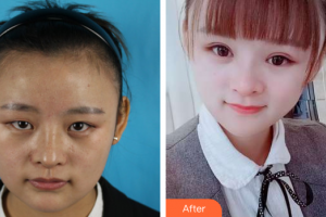 東莞中韓醫(yī)療美容診所劉琳整形價(jià)格表附眼部手術(shù)案例展示