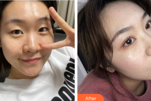 東莞中韓醫(yī)療美容診所秦東方整形價(jià)格表附眼部綜合案例展示