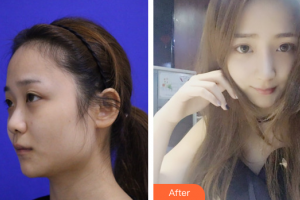 東莞華美女子醫(yī)學(xué)美容診所王曉潔整形價(jià)格表附鼻子塑造案例展示