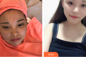 東莞康華醫(yī)院整形美容中心王春梅整形價(jià)格表附皮膚管理案例展示