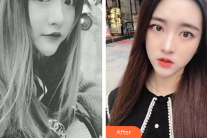 東莞康華醫(yī)院整形美容中心王德宏整形價(jià)格表附光學(xué)靚膚祛斑案例展示