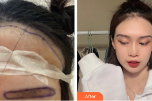 東莞康華醫(yī)院整形美容中心關(guān)志廣整形價(jià)格表附種植發(fā)際線案例展示