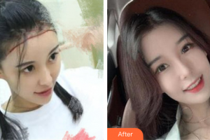 東莞東風(fēng)醫(yī)療美容中心黃杰整形價(jià)格表附種植發(fā)際線案例展示