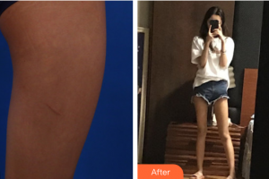 東莞南城人民醫(yī)院醫(yī)學(xué)整形美容中心黨小平整形價(jià)格表附大腿吸脂案例展示