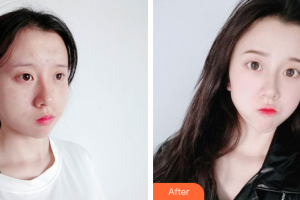 東莞市人民醫(yī)院醫(yī)學(xué)美容科整形價(jià)格表附祛痘案例展示