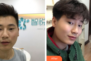 東莞市莞城人民醫(yī)院整形美容科羅少文整形價(jià)格表附激光祛痣案例展示