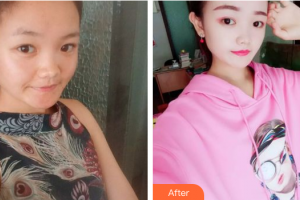 東莞東華醫(yī)院燒傷整形科蘇順清整形價(jià)格表附果酸換膚案例展示