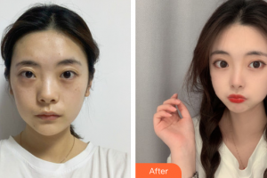 東莞市人民醫(yī)院醫(yī)學(xué)美容科劉玉生整形價(jià)格表附抗衰修復(fù)案例展示