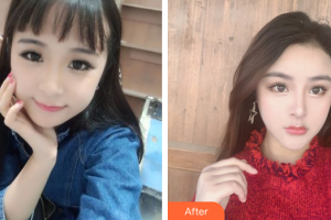 東莞知美整形醫(yī)院黃利整形價(jià)格表附膨體隆鼻案例展示