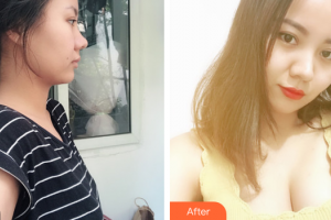 東莞知美整形醫(yī)院蘇萬(wàn)龍整形價(jià)格表附自體脂肪豐胸案例展示