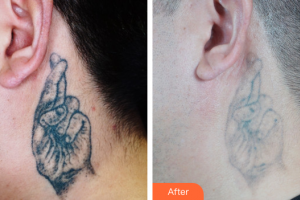 東莞知美整形醫(yī)院劉來(lái)君整形價(jià)格表附超激光美膚祛紋身案例展示