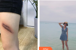 東莞市人民醫(yī)院醫(yī)學(xué)美容科廖旭鋒整形價(jià)格表附疤痕增生案例展示