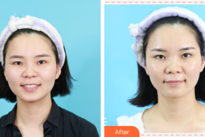 東莞東華醫(yī)院燒傷整形科劉玉琴整形價(jià)格表附激光美膚祛斑案例展示