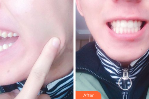 東莞知美整形醫(yī)院謝榮壽整形價(jià)格表附牙齒隱形矯正案例展示