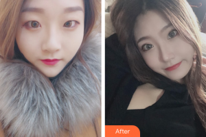 東莞知美整形醫(yī)院黃雙聞?wù)蝺r(jià)格表附雙眼皮案例展示