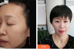 東莞美立方美容醫(yī)院臧劍芳整形價(jià)格表附DPLl祛斑案例展示