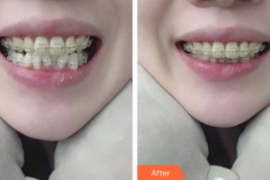 東莞美立方美容醫(yī)院楊文麗整形價(jià)格表附牙齒金屬矯正案例展示