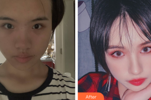 東莞美立方美容醫(yī)院林武龍整形價(jià)格表附面部埋線提升提升案例展示