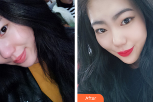 東莞美立方美容醫(yī)院王炳虓整形價(jià)格表附豐胸吸脂案例展示