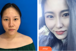 東莞百佳瑪麗亞婦產(chǎn)醫(yī)院陳蓉蓉整形價(jià)格表附微針祛痘嫩膚案例展示