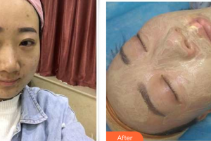 東莞百佳瑪麗亞婦產(chǎn)醫(yī)院趙楊整形價(jià)格表附微針案例展示