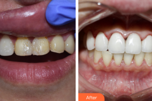 東莞康華醫(yī)院整形美容中心王篤權(quán)整形價(jià)格表附口腔美學(xué)貼面案例展示